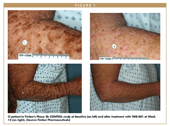 CI patient in Timber’s Phase 2b CONTROL study at baseline (on left) and after treatment with TMB-001 at Week 12 (on right). (Source: Timber Pharmaceuticals)