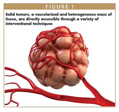 Solid tumors, a vascularized and heterogeneous mass of tissue, are directly accessible through a variety of interventional techniques