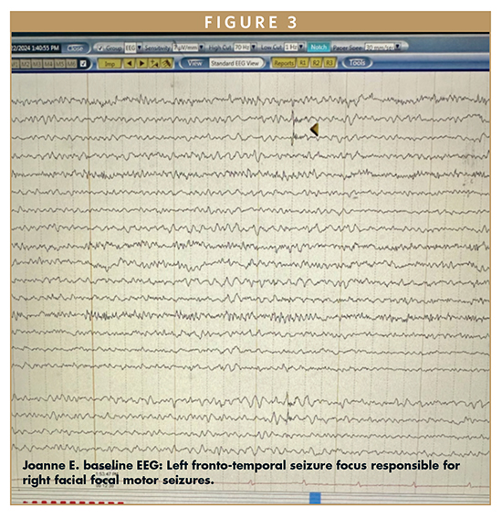 Joanne E. baseline EEG: Left fronto-temporal seizure focus responsible for right facial focal motor seizures.