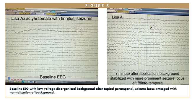 Baseline EEG with low voltage disorganized background after topical perampanel, seizure focus emerged with normalization of background.